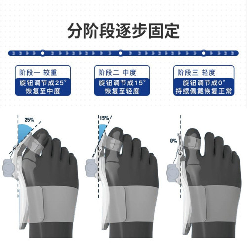 旋鈕大拇指外翻腳趾矯正器大腳骨重曡分趾器母趾頭分離器可調節